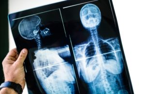 Osteoporoza – Przyczyny, objawy i leczenie osteoporoza